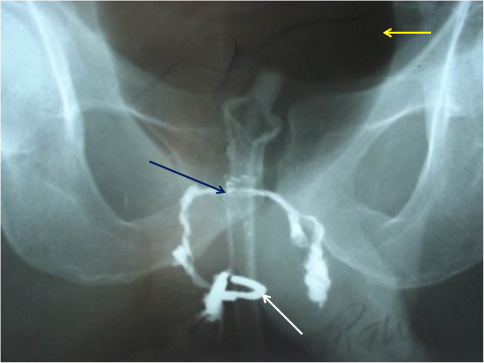 Fistulagrams Farmington