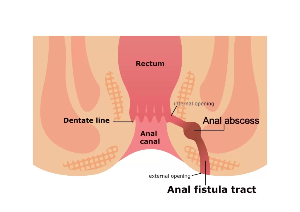 Fistulagrams Farmington