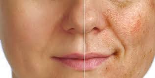 Diffuse Pigmentation
