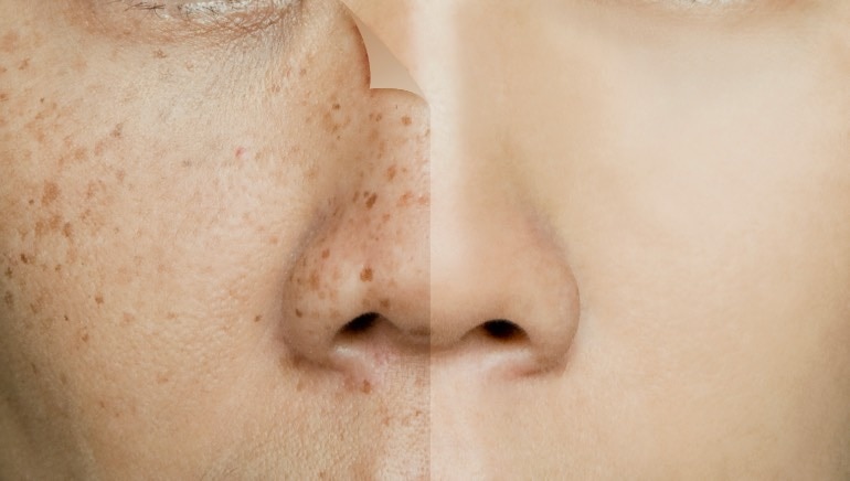 Diffuse Pigmentation