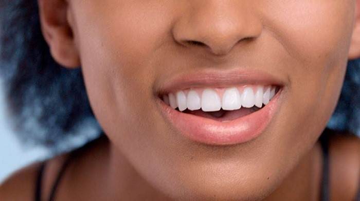 Gums Depigmented